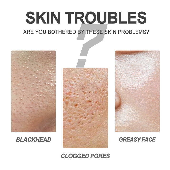 EELHOE Blackhead Cleansing Cream: The Pore Purge You've Been Waiting For